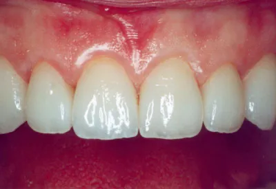 Smile after porcelain veneer treatment