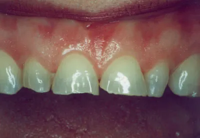 Front teeth before porcelain veneer treatment