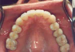 Upper teeth after tooth-colored restorations