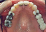 Upper teeth before tooth-colored restorations