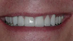 Smile after cosmetic dental treatment, gallery case 1 detail view