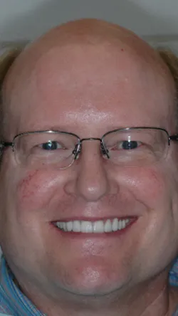 Smile after cosmetic dental treatment