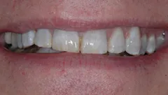 Smile before cosmetic dental treatment, gallery case 1 detail view