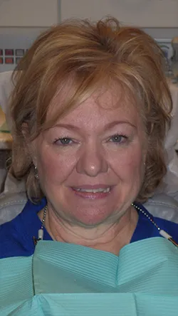 Smile before cosmetic dental treatment