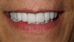 Smile after cosmetic dental treatment, gallery case 1 detail view