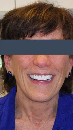 Smile after cosmetic dental treatment, gallery case 1 detail view