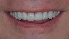 Smile after cosmetic dental treatment, gallery case 2 detail view