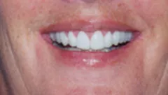 Smile after cosmetic dental treatment, gallery case 6 detail view