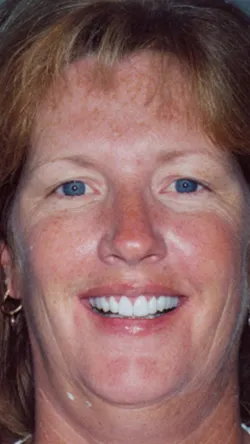 Smile after cosmetic dental treatment, gallery case 6