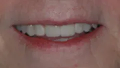 Smile after cosmetic dental treatment, gallery case 8 detail view