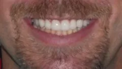 Smile after cosmetic dental treatment, gallery case 9 detail view