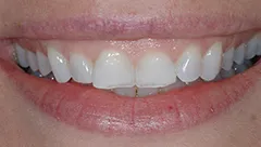 Smile before cosmetic dental treatment, high school reunion case