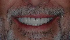 Smile after cosmetic dental treatment, gallery case 10 detail view