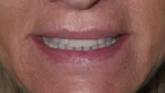 Smile after cosmetic dental treatment, gallery case 13 detail view