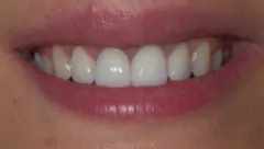 Smile after cosmetic dental treatment, gallery case 14 detail view