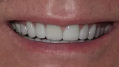 Smile after cosmetic dental treatment, gallery case 15 detail view