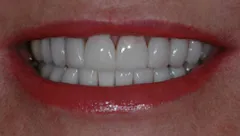 Smile after cosmetic dental treatment, gallery case 16 detail view