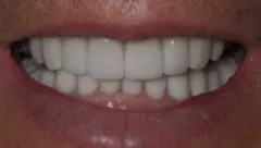 Smile after cosmetic dental treatment, gallery case 17 detail view