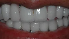 Smile after cosmetic dental treatment, gallery case 18 detail view