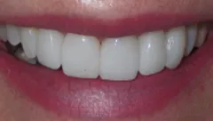 Smile after cosmetic dental treatment, gallery case 19 detail view