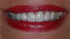 Smile after cosmetic dental treatment, gallery case 20 detail view
