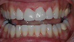 Smile after cosmetic dental treatment, gallery case 21 detail view