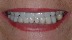 Smile after cosmetic dental treatment, gallery case 22 detail view