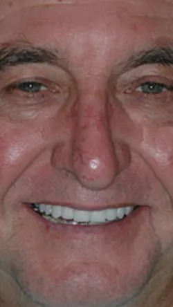 Smile after cosmetic dental treatment, gallery case 25