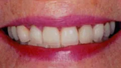 Smile after cosmetic dental treatment, gallery case 27 detail view