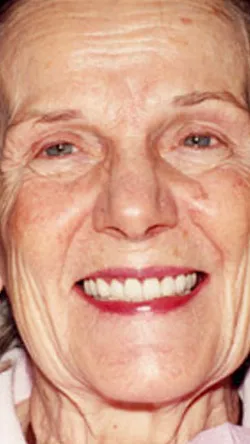 Smile after cosmetic dental treatment, gallery case 27