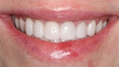Smile after cosmetic dental treatment, gallery case 28
