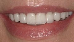 Smile after cosmetic dental treatment, gallery case 29