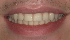 Smile after cosmetic dental treatment, gallery case 31