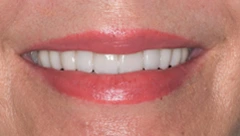 Smile after cosmetic dental treatment, gallery case 32