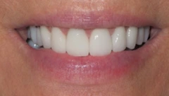 Smile after cosmetic dental treatment, gallery case 34