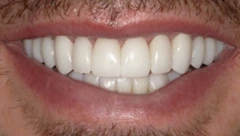 Smile after cosmetic dental treatment, gallery case 35