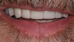 Smile after cosmetic dental treatment, gallery case 36