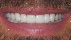 Smile after cosmetic dental treatment, gallery case 37