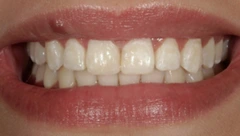 Smile after cosmetic dental treatment, gallery case 38