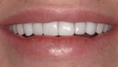 Smile after cosmetic dental treatment, gallery case 39