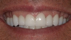 Smile after cosmetic dental treatment, gallery case 41