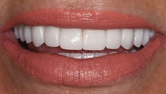 Smile after cosmetic dental treatment, gallery case 42