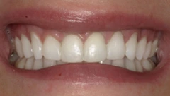 Smile after cosmetic dental treatment, gallery case 44