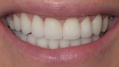 Smile after cosmetic dental treatment, gallery case 46