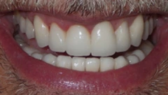 Smile after cosmetic dental treatment, gallery case 49