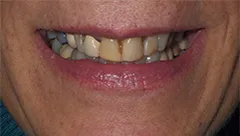 Smile before cosmetic dental treatment, gallery case 1 detail view