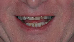 Smile before cosmetic dental treatment, gallery case 2 detail view