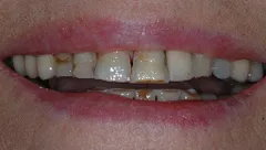 Smile before cosmetic dental treatment, gallery case 3 detail view