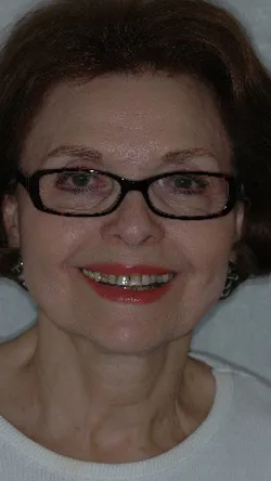 Smile before cosmetic dental treatment, gallery case 3