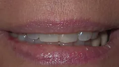 Smile before cosmetic dental treatment, gallery case 5 detail view